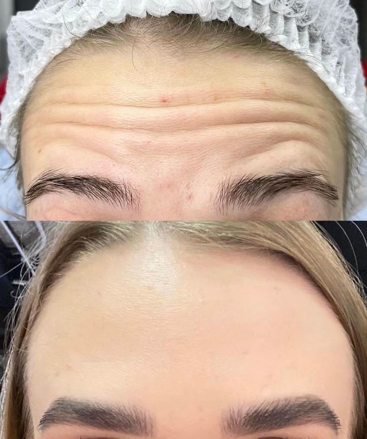 Botox